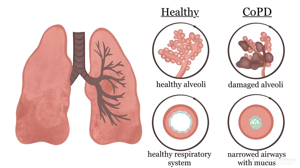 KOAH hastası ne yapmalı?