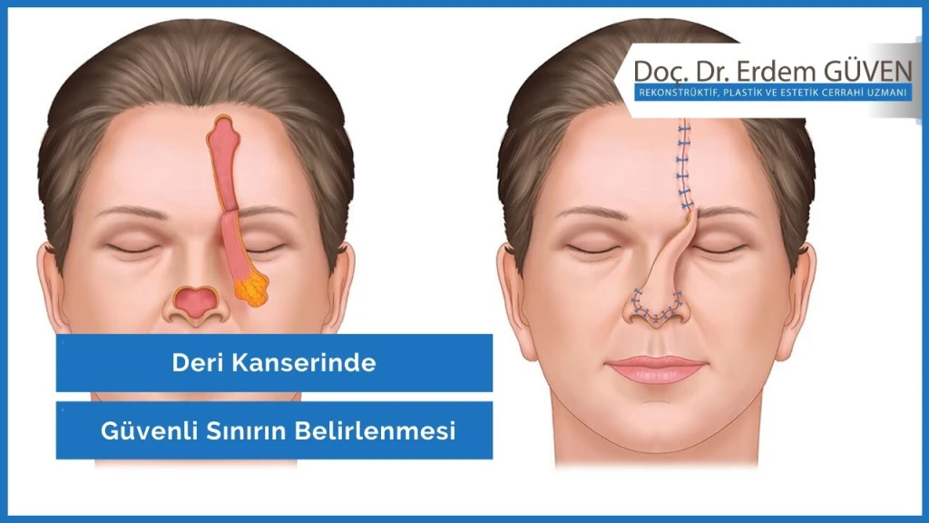 Cilt Kanseri Ameliyatını Hangi Doktor Yapar?