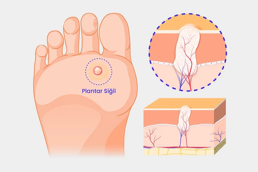 Ayakta Siğil Tedavisi