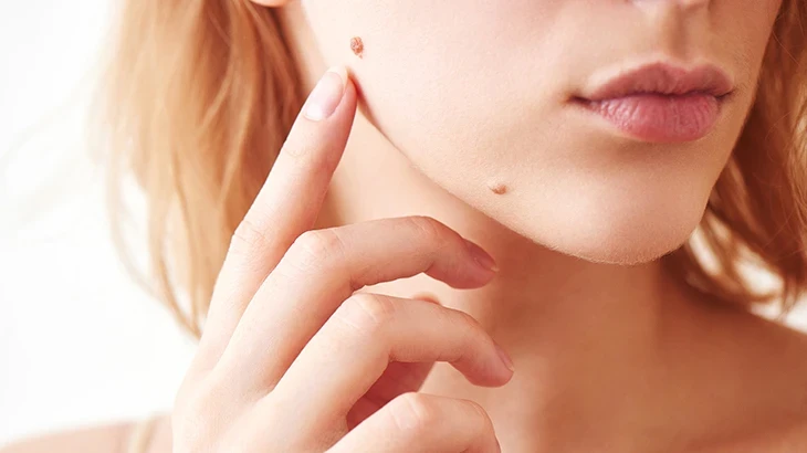 Yüzdeki Ben Aldırma Fiyatları