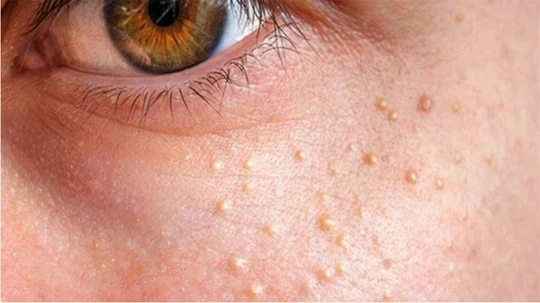 Yüzde Yağ Bezesi Gibi Sivilce