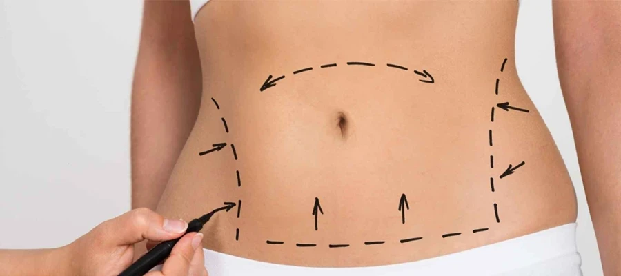 Karın Germe Estetiği Nedir ? Nasıl Olur ?