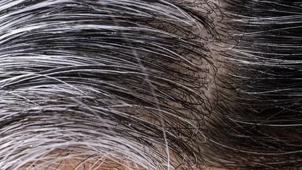 Saç Beyazlamasına Çözüm ve Önleme