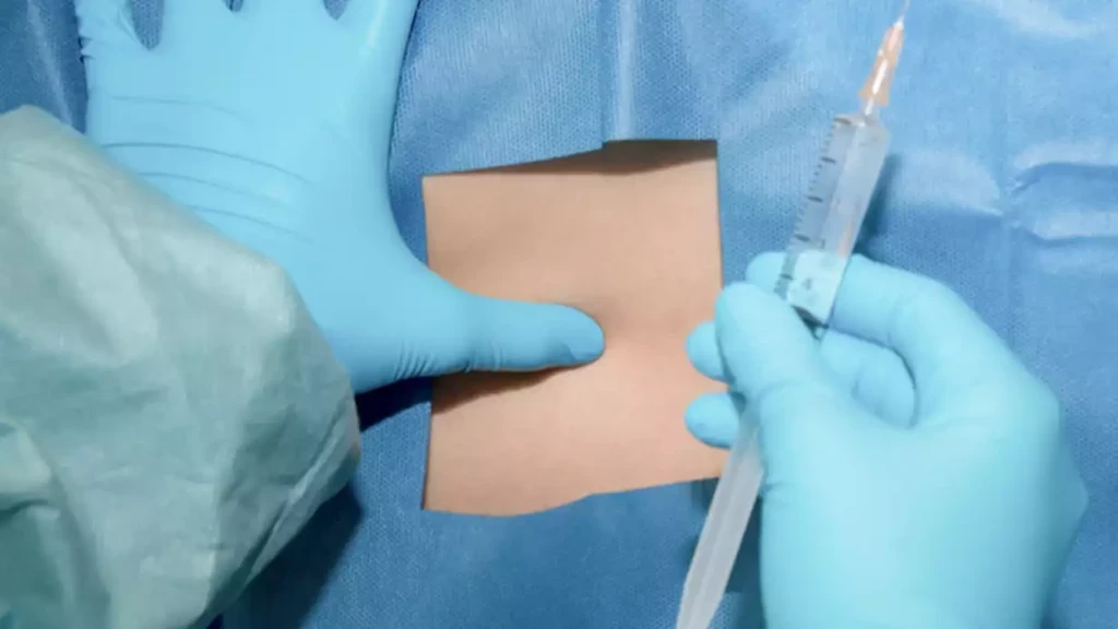 Spinal Sezaryen Nedir?