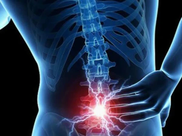 Bel Fıtığı Belirtileri Nelerdir? Bel Fıtığı Neden Olur?