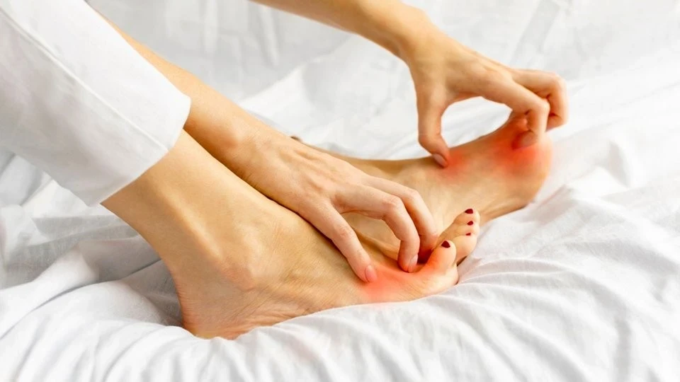 Ayak Mantarına Denenmiş Doğal Etkili Çözümler