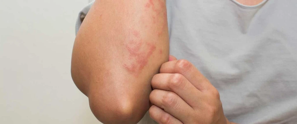 İsilik Nedir? Belirtileri, Nedenleri ve Tedavisi Nedir?