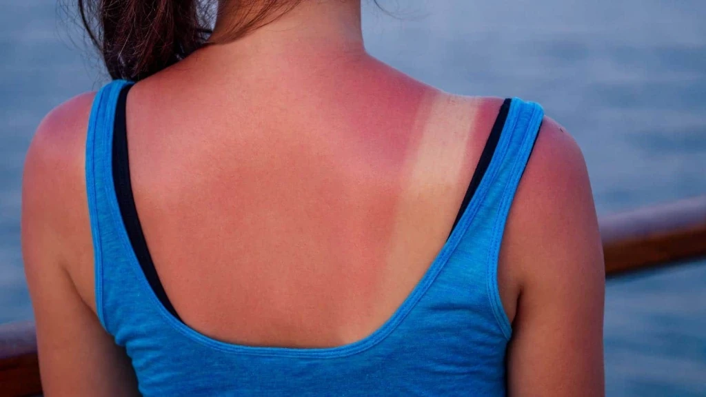 Güneş Yanığına Ne İyi Gelir?