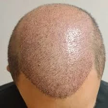 Ars Hair Transplantasyon Station/ İzmit - Gölcük Saç Ekim