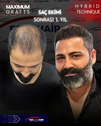 Balıkesir Saç Ekim Merkezi