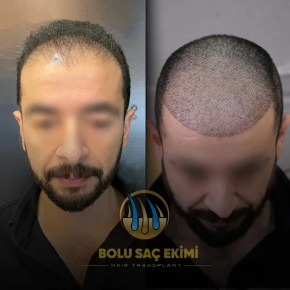 Bolu Saç Ekimi Merkezi