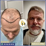 Gaziantep Fue Saç Ekim - Docshair Arif Uğur