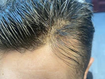 Nevsehir Protez Saç