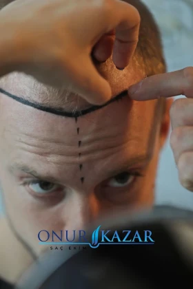 Onur Kazar Aksaray Saç Ekimi Merkezi - Prp - Mezoterapi - Kaş,Bıyık,Sakal Ekimi