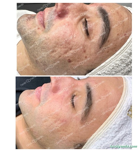 Deniz Damla Çukurambar | Ankara Cilt Bakımı | Ankara Lazer Epilasyon | Kalıcı Makyaj | Protez Tırnak