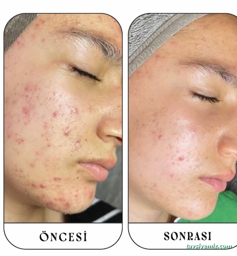 Aris Ezgi Doğan Balıkesir Güzellik Merkezi | Balıkesir Lazer Epilasyon | Balıkesir Cilt Bakımı