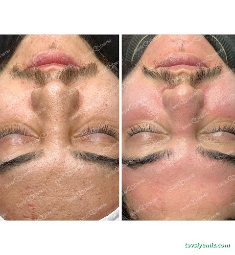 Deniz Damla Çukurambar | Ankara Cilt Bakımı | Ankara Lazer Epilasyon | Kalıcı Makyaj | Protez Tırnak