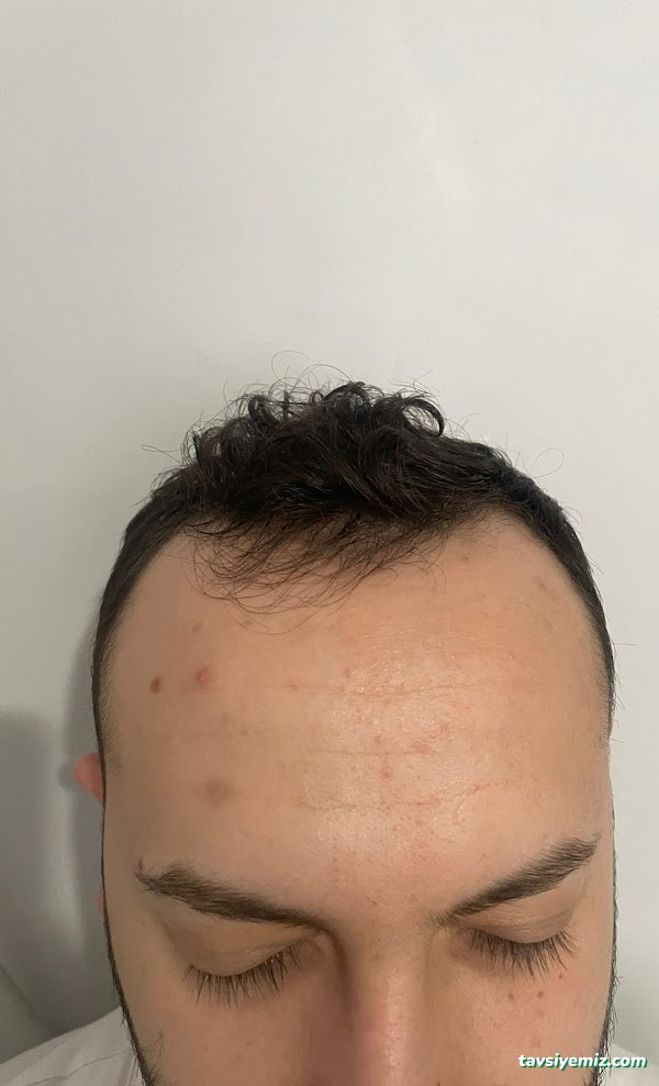 İbrahim Erayhan-Saç Ekimi-Bursa Tıp Merkezi - Hairtransplant Clinic