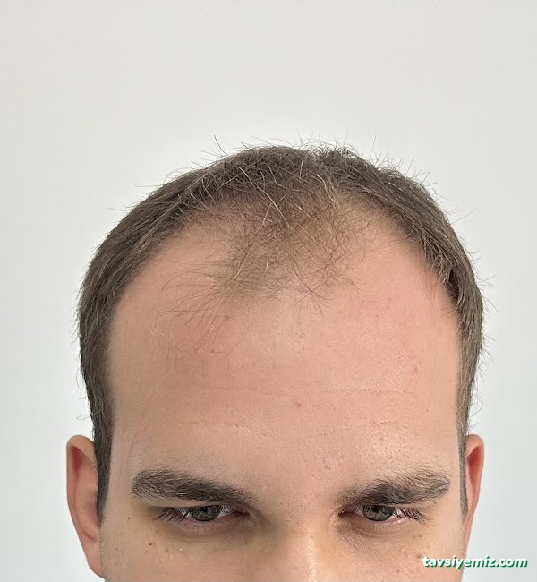 İbrahim Erayhan-Saç Ekimi-Bursa Tıp Merkezi - Hairtransplant Clinic