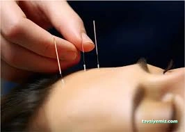 Akupunktur Ozon Dr.sevinc.f