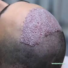 Ars Hair Transplantasyon Station/ İzmit - Gölcük Saç Ekim