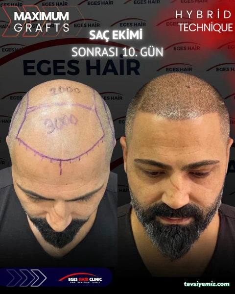 Balıkesir Saç Ekim Merkezi