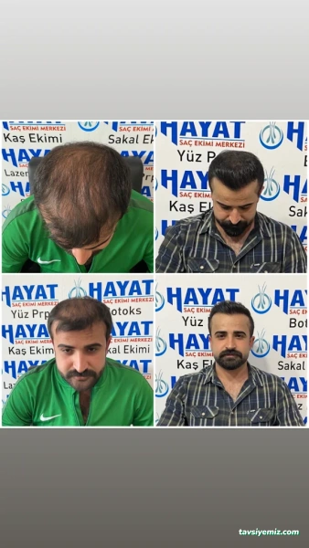 Batman Hayat Saç Ekim&Güzellik Merkezi