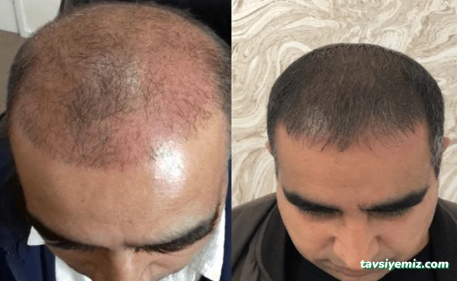 Bayburt Saç Ekim Merkezi