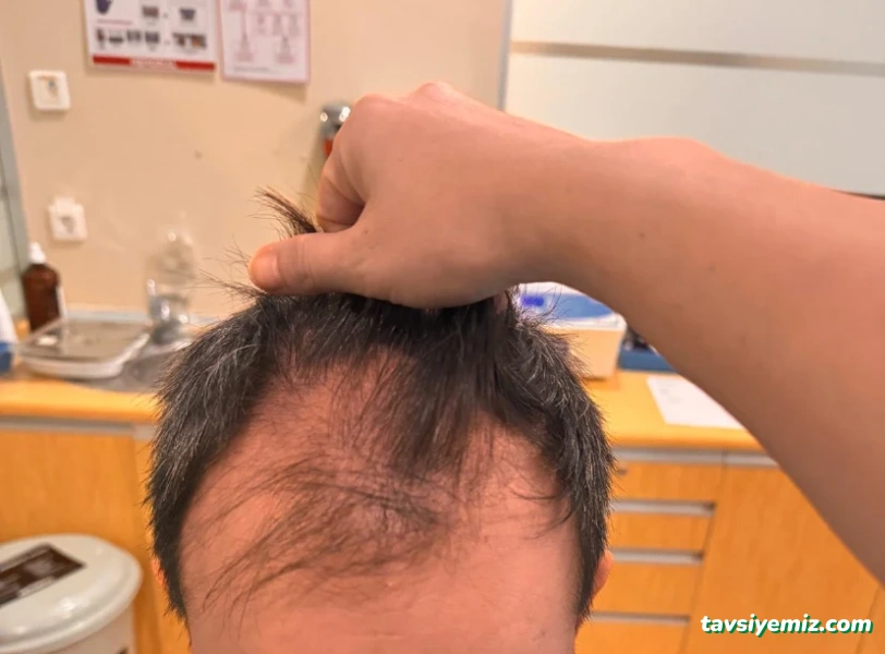 Bilyana Hair Clinic Saç Ekim Merkezi