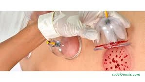 Bitlis Sülük İle Tedavi Merkezi