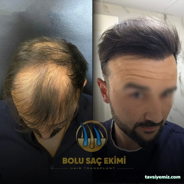 Bolu Saç Ekimi Merkezi