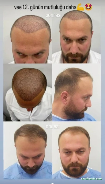 Bor-Ay Güzellik Merkezi Ve Saç Ekimi