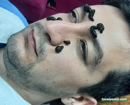 Bursa Hacamat Merkezi, Manuel Terapi(Boyun Fıtığı, Bel Fıtığı, Sırt Ağrıları), Sülük Tedavisi