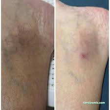 Çanakkale Akupunktur