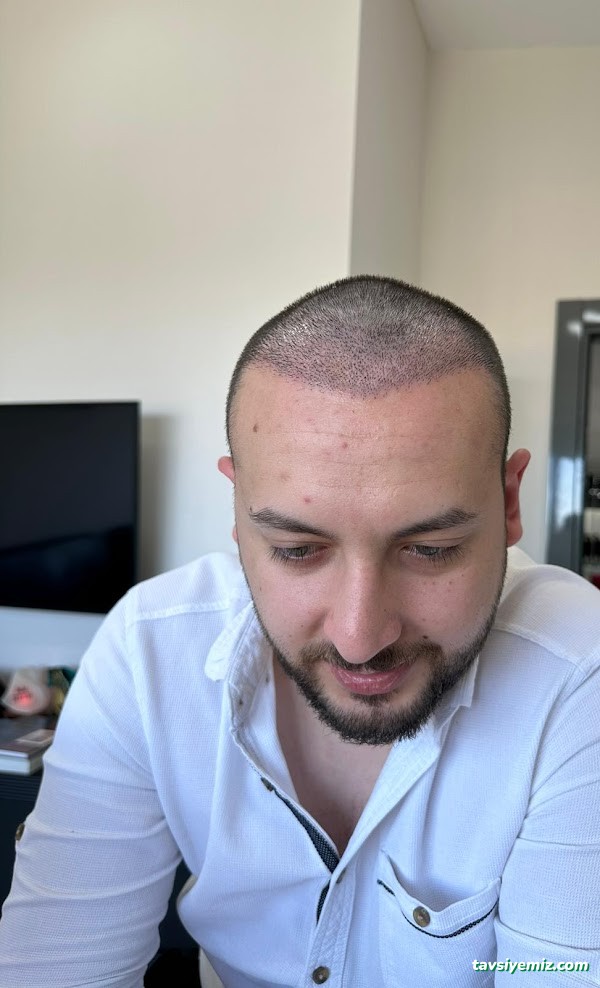 İbrahim Erayhan-Saç Ekimi-Bursa Tıp Merkezi - Hairtransplant Clinic