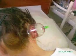 Çorum Bayan Hacamat