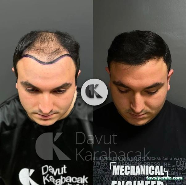 Davut Karabacak Saç Ekim Merkezi