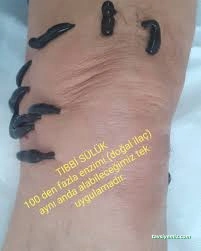 Diyarbakır Kayapınar Hacamat & Tıbbi Sülük