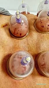 Diyarbakır Kayapınar Hacamat & Tıbbi Sülük