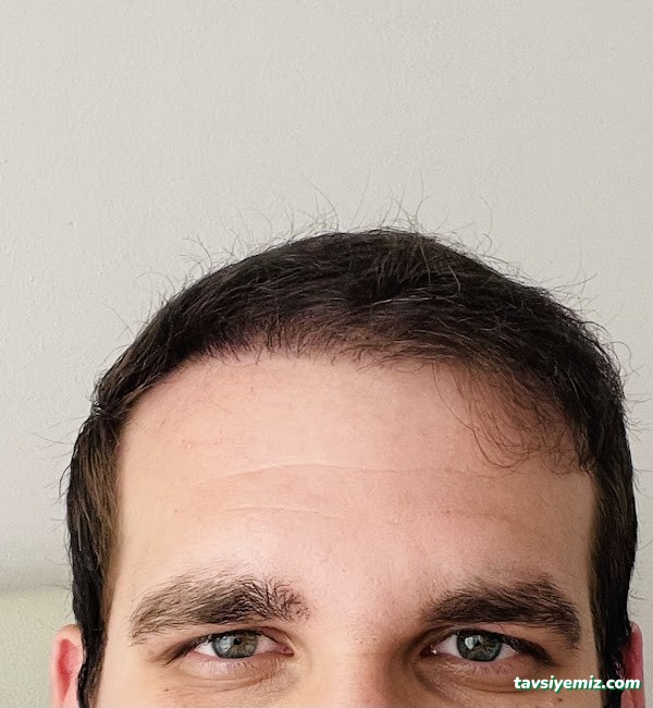 İbrahim Erayhan-Saç Ekimi-Bursa Tıp Merkezi - Hairtransplant Clinic