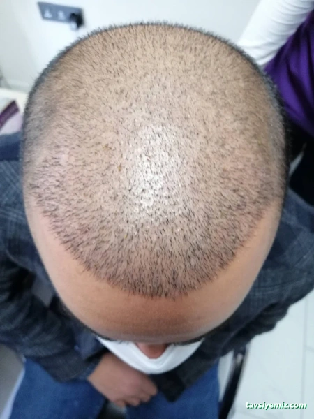 Estewolf Hair Kayseri Saç Ekimi