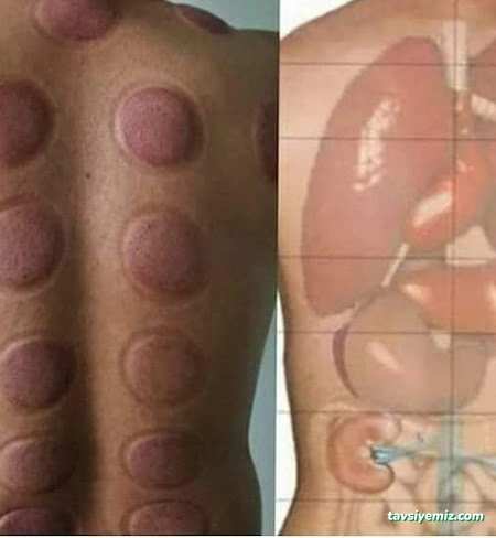 Hacamat Rukye Hasta Bakıcı