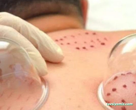 Hacamat Rukye Hasta Bakıcı