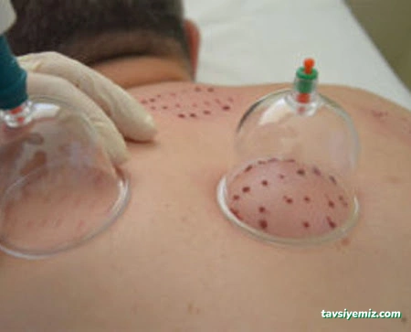 Hacamat Rukye Hasta Bakıcı