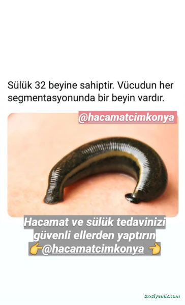 Hacamatcım Konya (Hacamat Konya)