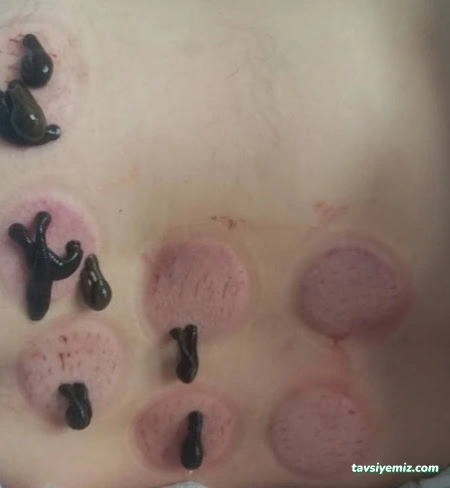 Hacamatcım Konya (Hacamat Konya)