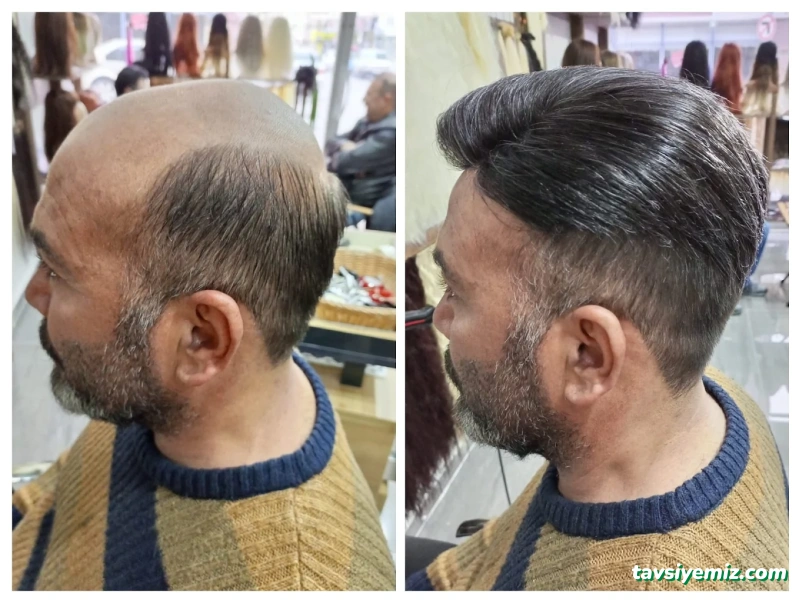 Karaman Protez Saç Ve Peruk Merkezi