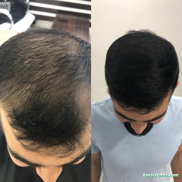 Mde Hair Saç Ekim Merkezi