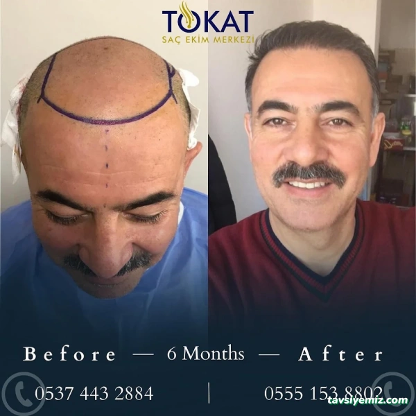 Tokat Saç Ekimi Merkezi | Tokat Hair Clinic