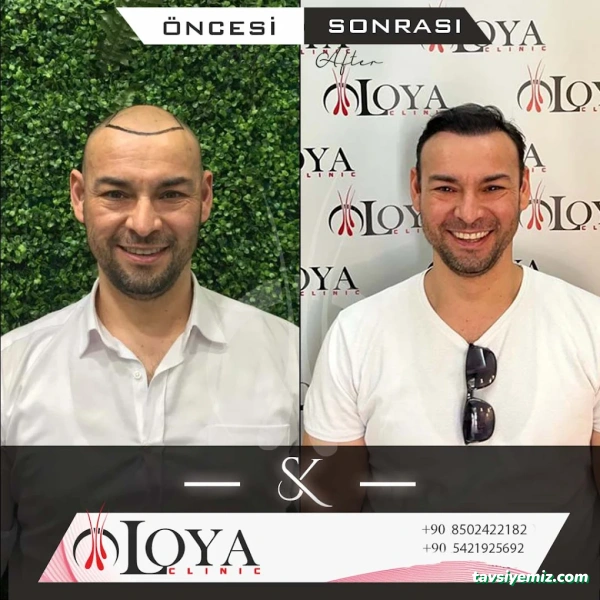 Uşak Saç Ekim Merkezi | Loya Clinic
